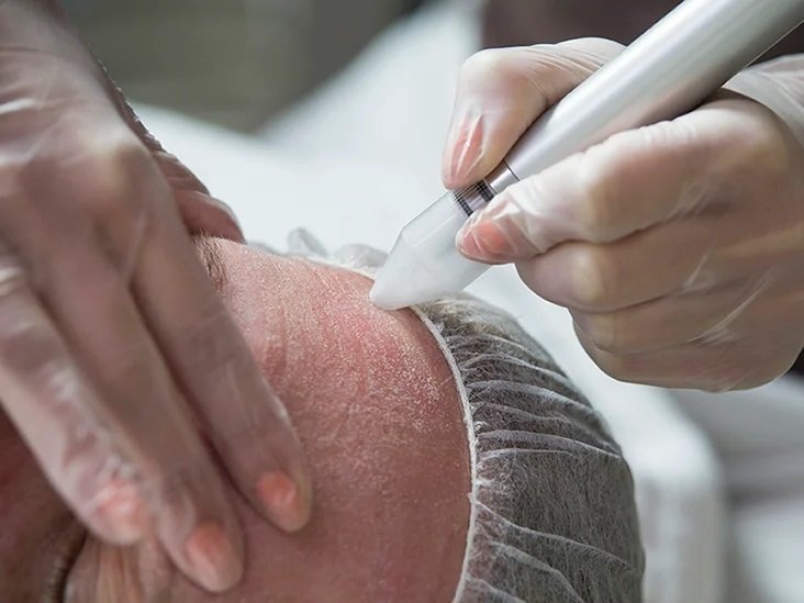 Dermabrasion Dermabrasion