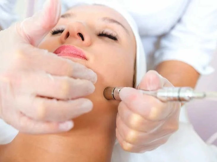 Microdermabrasion